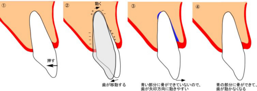 歯 の 動揺 固定