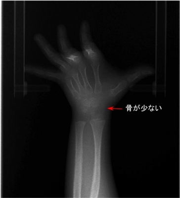 手のレントゲンとあごの骨の成長 そえじま矯正歯科