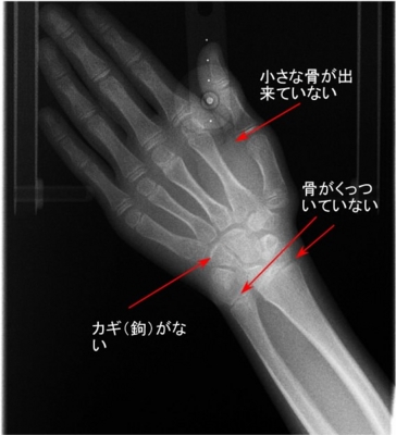 手のレントゲンとあごの骨の成長 そえじま矯正歯科