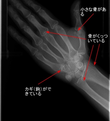 手のレントゲンとあごの骨の成長 そえじま矯正歯科