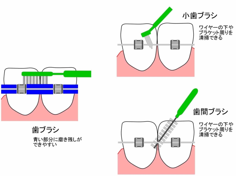 矯正治療中の歯磨き そえじま矯正歯科