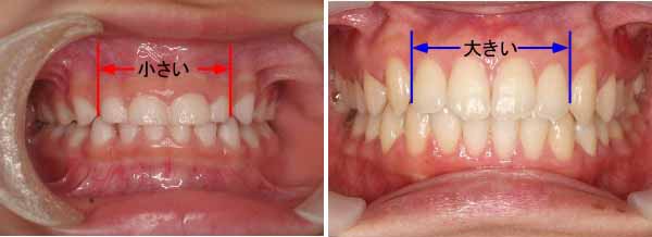 乳歯と永久歯の大きさの違い | そえじま矯正歯科