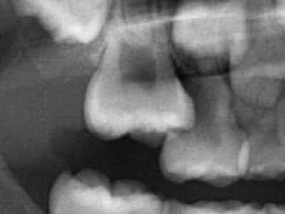 レントゲン 乳歯 乳歯の生え変わりの時、歯並びを悪くしないための対処法
