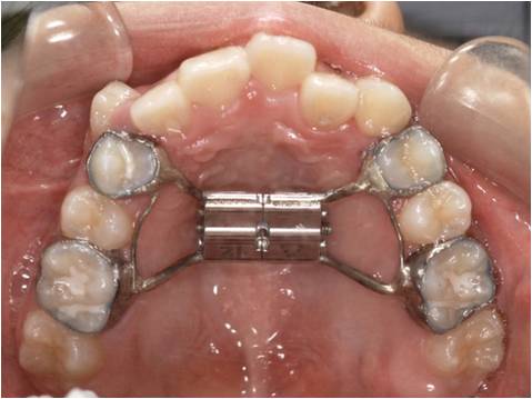 上顎 拡大 装置