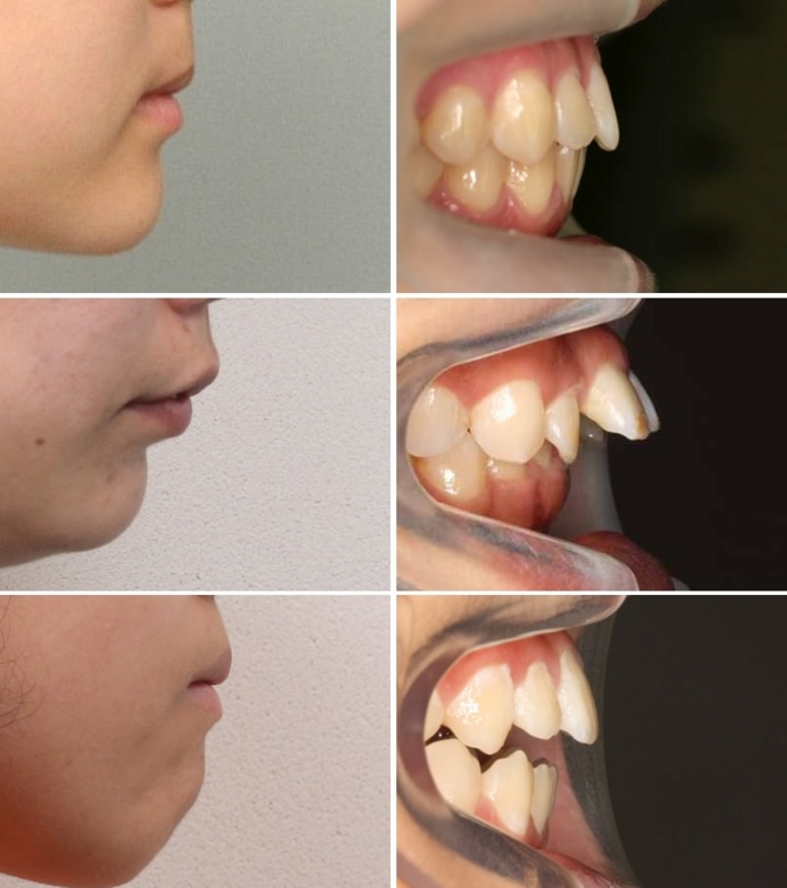 上下の前歯の距離と口元の印象 そえじま矯正歯科